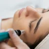 Microneedling